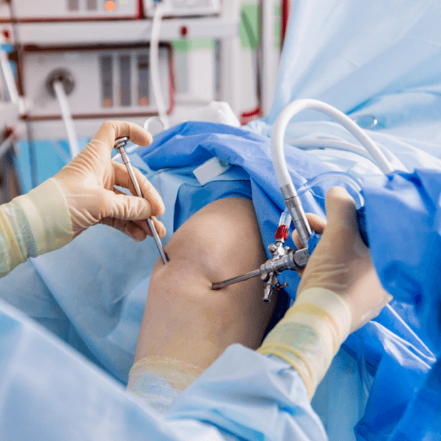 Arthroscopic Bankart’s repair