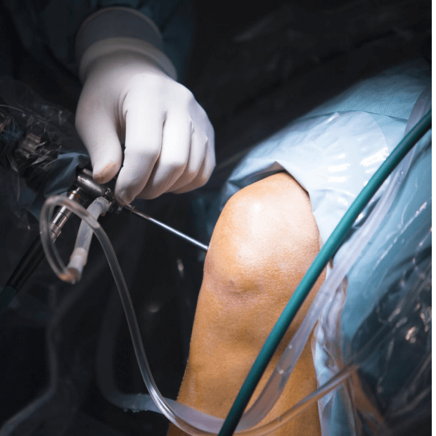 Arthroscopic Bankart’s repair