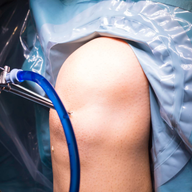 Arthroscopic Bankart’s Repair