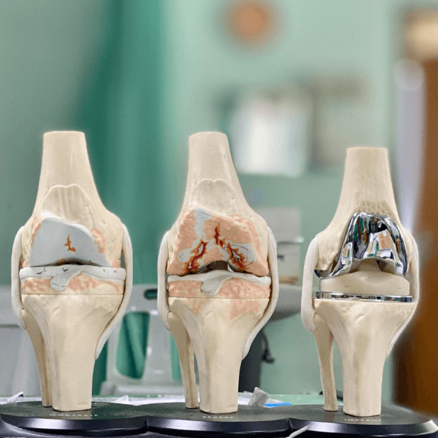 Cartilage Repair models