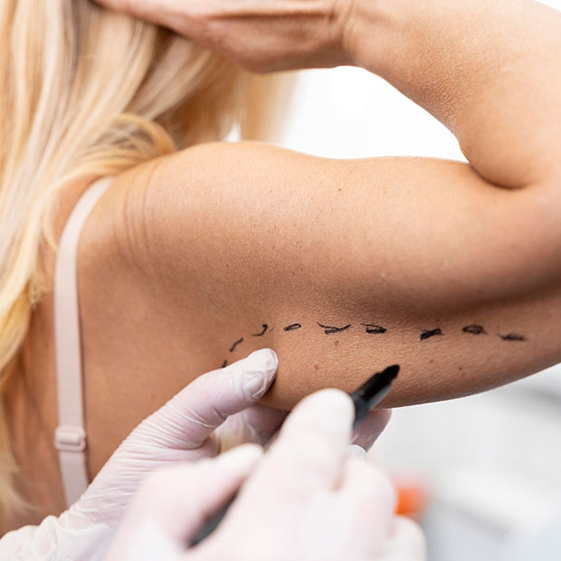 acromioplasty