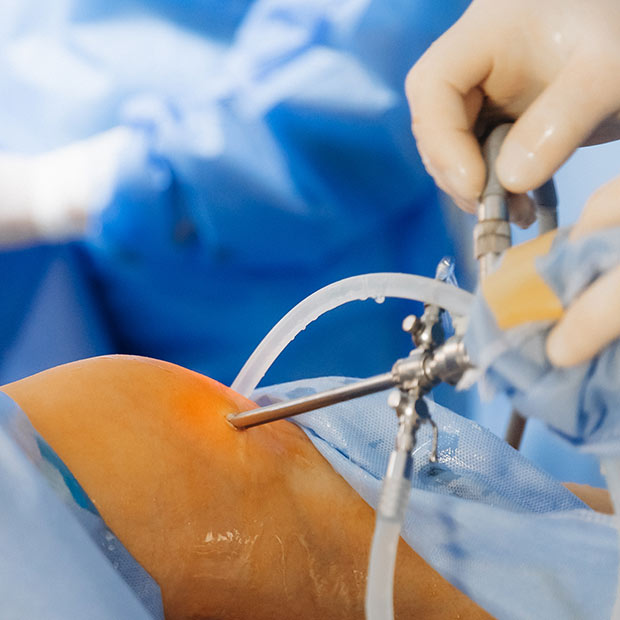 Arthroscopic Rotator Cuff Repair